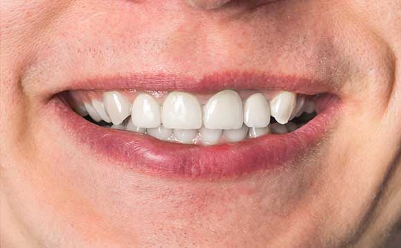 Broken Tooth | Nataupsky Family Dentistry