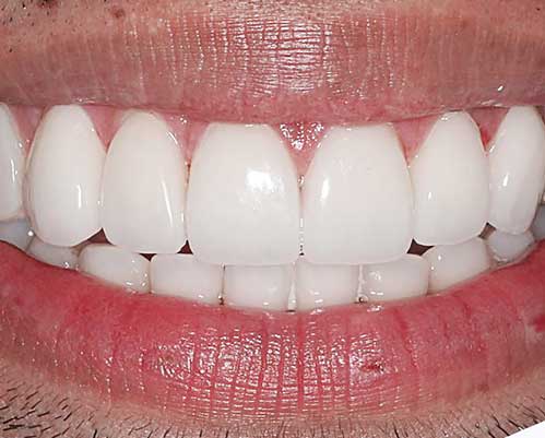 Crowded Teeth | Nataupsky Family Dentistry