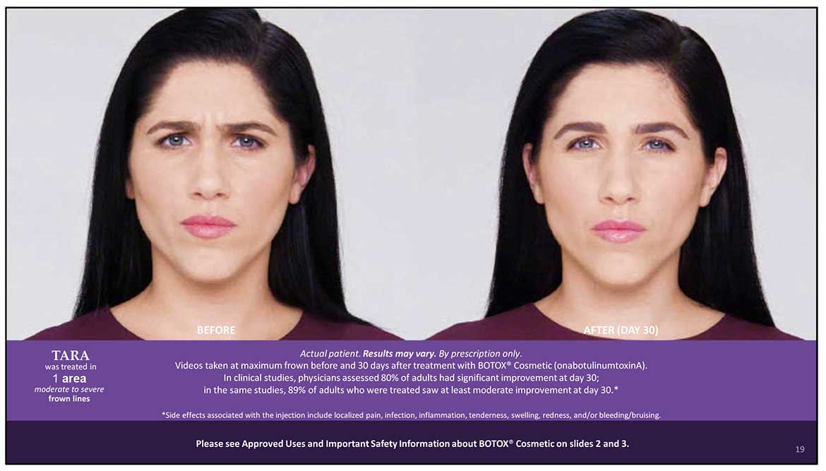 BOTOX Cosmetic Before and After | Dr. Nataupsky Family Dentistry