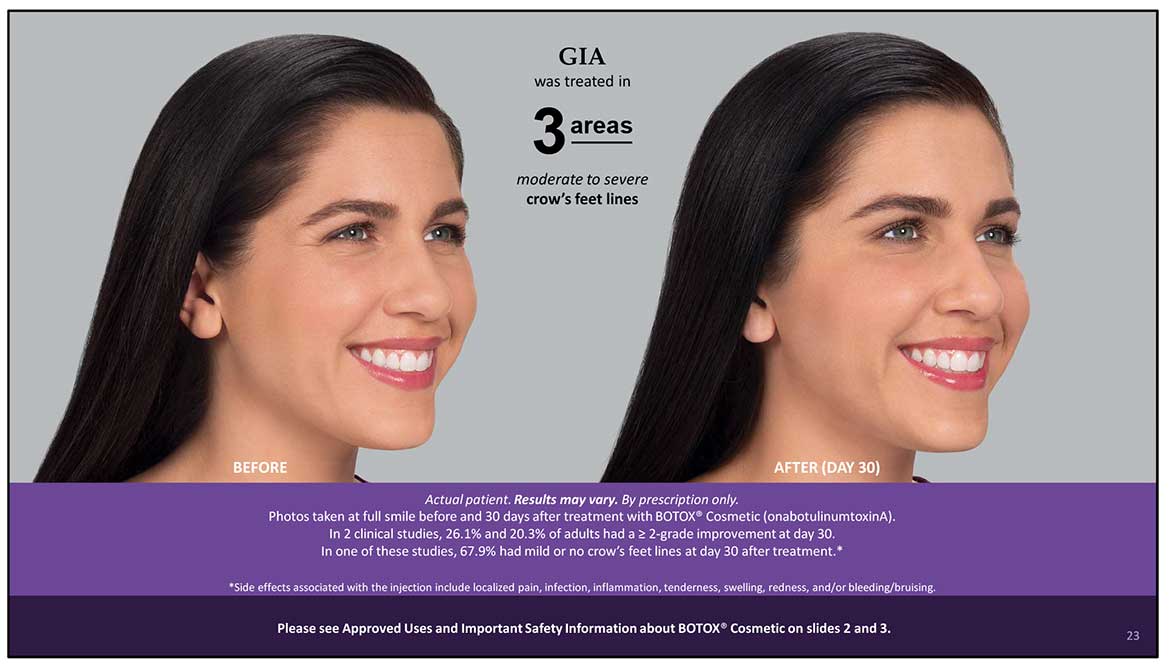 BOTOX Cosmetic Before and After | Dr. Nataupsky Family Dentistry